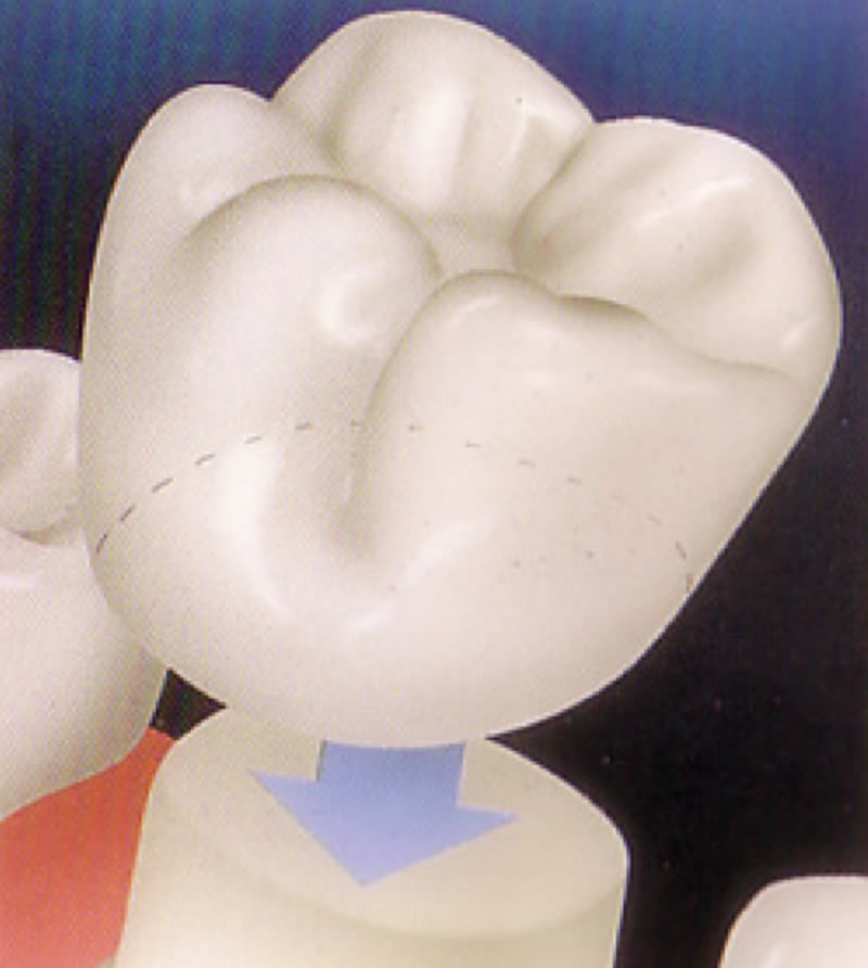 Dental Crowns