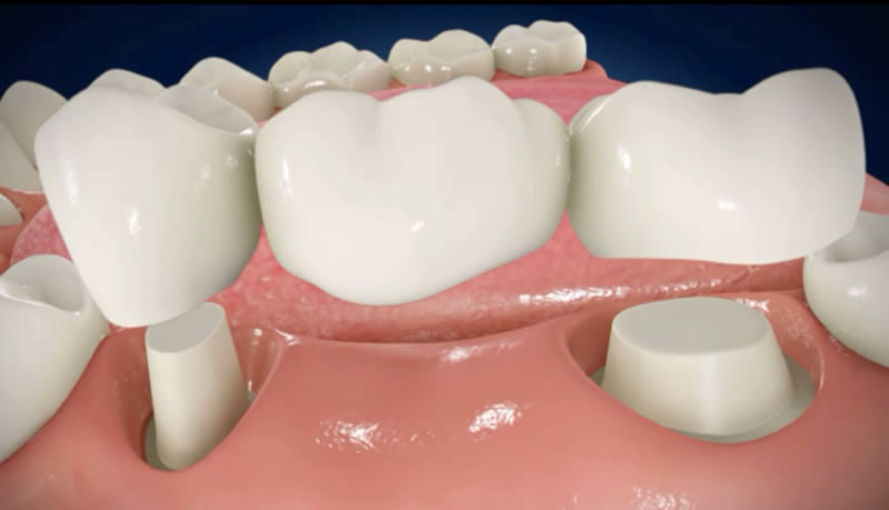 Dental Crowns