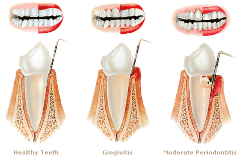 Gum Disease Therapy