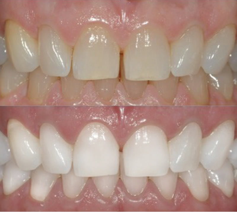 Teeth Whitening-